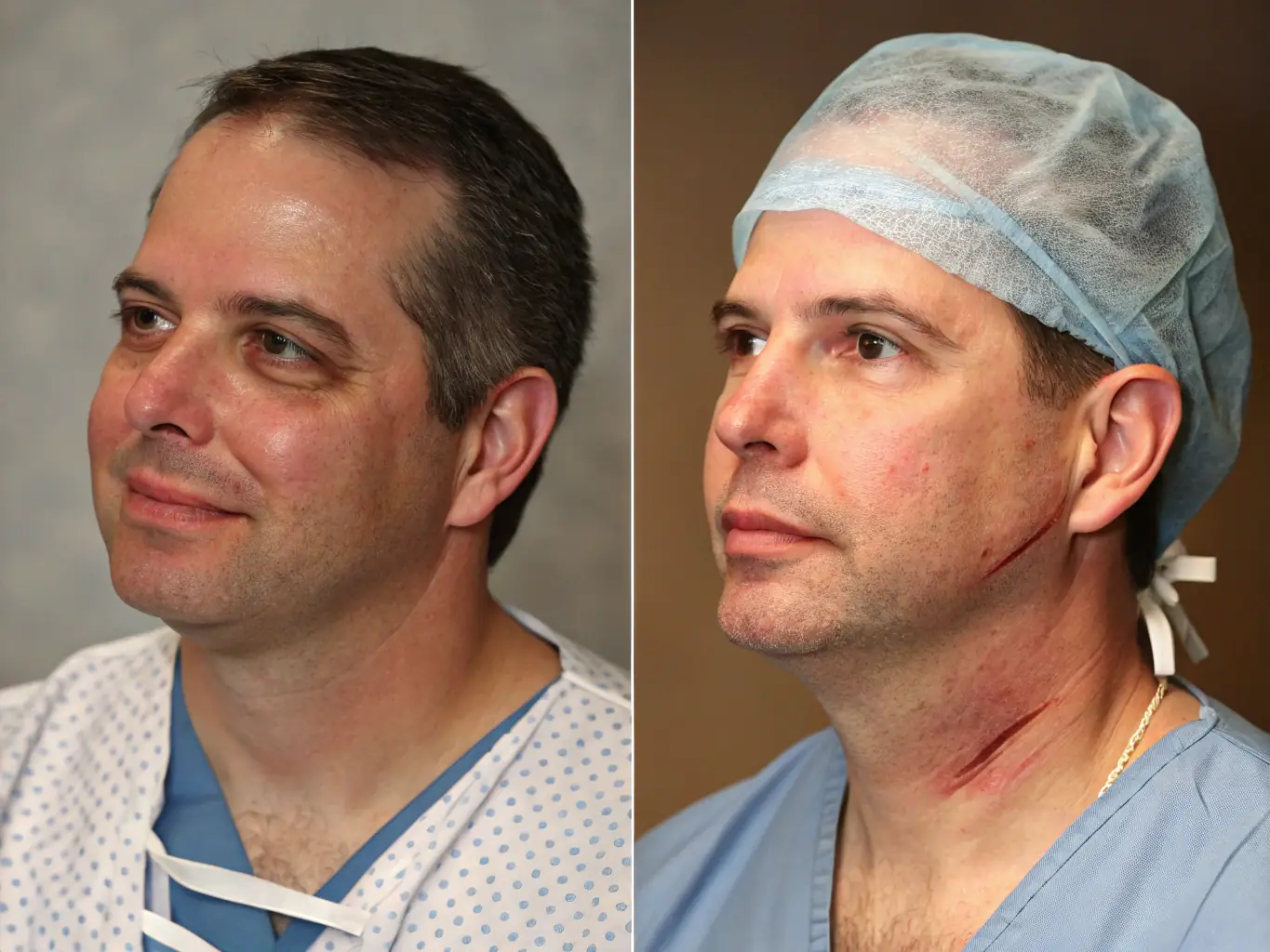 A side profile image of a patient before and after jaw correction surgery, showcasing improved facial harmony.